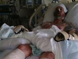 개가 핥기만 했을 뿐인데 사지 절단…원인은 침 속 세균