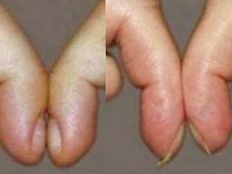 '손톱 굽은 사람'이 심각하게 의심해 봐야 하는 '질환'