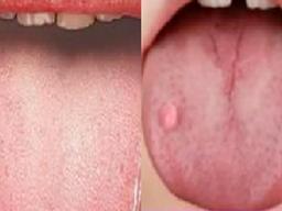 혓바닥에 생긴 <strong>혹</strong>이 죽음의 신호? 초간단 건강 진단법