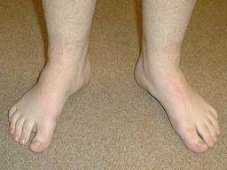 ‘팔자걸음 안 돼!’ 건강을 해치는 잘못된 걸음걸이와 올바른 걷기 방법