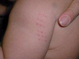 BCG 경피용 <strong>백신</strong> 비소 검출 논란.. 문제 <strong>백신</strong> 맞았나 확인방법은?