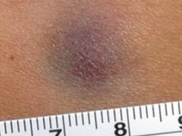 6년 간 어깨에 있던 1㎝ 붉은 멍, 알고보니 <strong>피부암</strong>