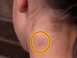 대부분의 사람들이 무시하는 암의 초기증상