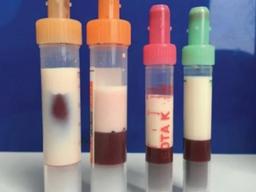 하얗게 변해버린 혈액… 정상보다 94배 많은 <strong>지방</strong> 때문이었다