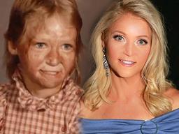 전신 화상 입은 10살 소녀, 38년 만에 <strong>미인대회</strong> 꿈 이루다