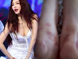 눈에 띄는 멍든 다리때문에 뜻밖의 <strong>논란</strong>중인 <strong>아이돌</strong>의 근황