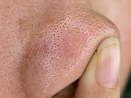 누구나 손 쉽게 할 수 있는 10분 블랙헤드 제거하는 꿀팁