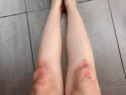 '컴백 예고' 선미, 멍투성이 된 다리 눈길…연습의 흔적