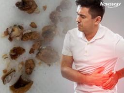 여름에 심해지는 고통…‘요로결석’의 공포