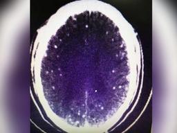 ‘훠궈’ 먹은 中남성 뇌에서 기생충 수백마리 발견…왜?