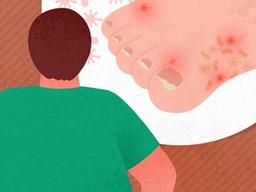 이젠 '뽀송뽀송' 김 대리는 어떻게 무좀을 잡았나