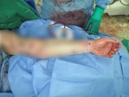 "軍병원으로 옮긴 이국종 제자…절단 위기 <strong>장병</strong> 팔 살렸다"