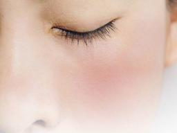 겨울철 `안면홍조` 관리하세요!