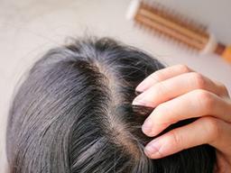 "나이 탓일까?…" 풍성했던 머리, 폭삭 꺼진 이유