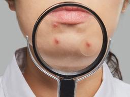 중장년 여드름, 회춘 상징 아니라 <strong>주사</strong>?