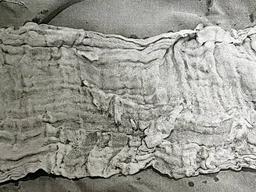 출산 후 시작된 고통…배 속에서 나온 15㎝ 대형 거즈