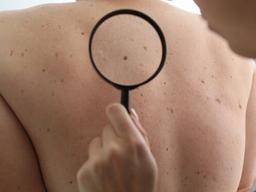 점인 줄 알았더니 피부암? 일반 점과 '<strong>흑색종</strong>'의 차이