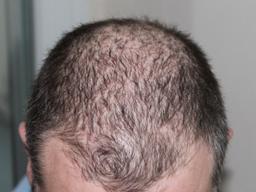 의사 얼굴도 못봤는데…`탈모 진료비` 고무줄 청구