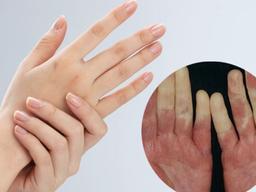 단순 <strong>수족냉증</strong>이라 여기면 큰일! 피부색 변하는 레이노 증후군