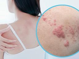 걸리면 너무 아픈 '<strong>대상포진</strong>'도 전염될까?