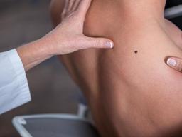 점인줄 알았는데, 암이라고요? 내 몸에 '흑색종'을 찾아라!