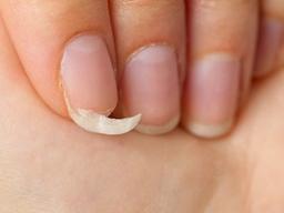 쉽게 부서지는 <strong>손톱</strong>…'이 영양분' 부족 때문?