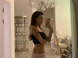 피멍으로 뒤덮인 전신…유튜버 아옳이, 무슨 주사 맞았길래