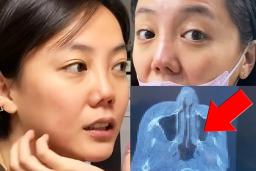 코 수술 고백한 여배우 심각한 현재 상황 공개됐다