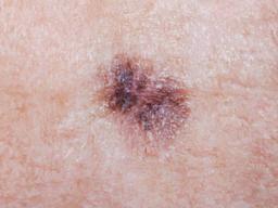 그냥 피부에 난 '점'인줄 알고 놔뒀다가 위험한 '암'이 될 수도 있다