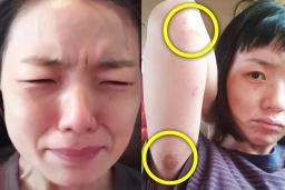 온몸이 상처로 도배…건강상태 심각해 보인다는 개그우먼의 최근자 모습