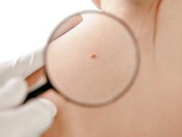 양성종양이면 꺼림칙해도 <strong>안심</strong>? 무조건 없애야할 '3가지 경우'