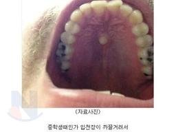 입천장에 난 <strong>치아</strong> 레전드... ㄷㄷㄷ