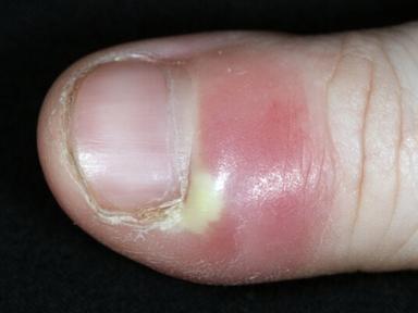 손톱 거스러미, 무심코 뜯다간 ‘조갑주위염’ 위험