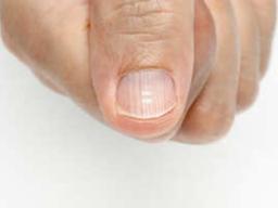 “손톱 세로줄은 단백질 부족?”…손톱으로 확인하는 <strong>건강</strong> 적신호 3가지